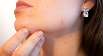 Attenzione: ecco i cibi e le bevande che favoriscono la comparsa dei brufoli